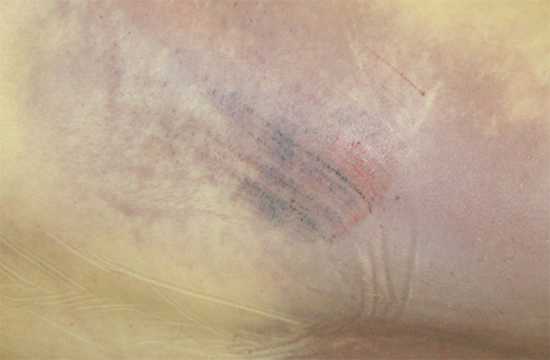 abrasion