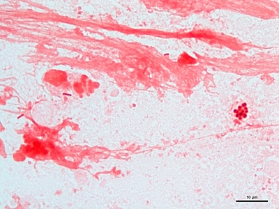 Gram negative pneumonia 01