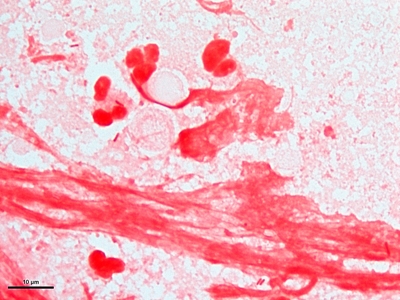 Gram negative pneumonia 02