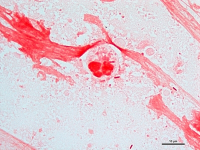 Gram negative pneumonia 03