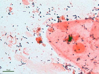 Reject sputum specimen 02