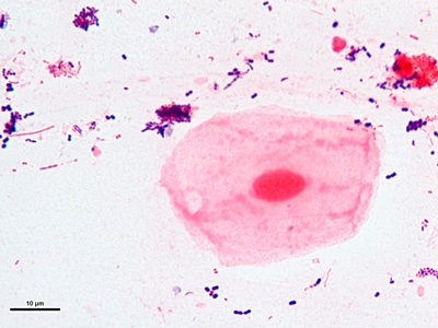 Reject sputum specimen 03