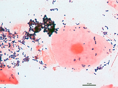 Reject sputum specimen 04