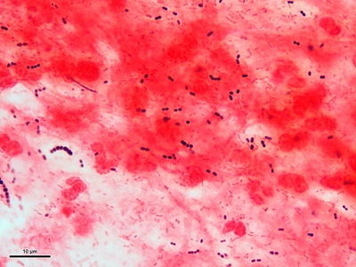 Haemophilus and S. pneumoniae pneumonia 01