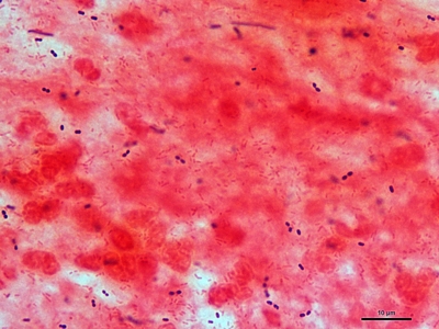 Haemophilus and S. pneumoniae pneumonia 02