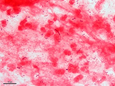 Haemophilus and S. pneumoniae pneumonia 03
