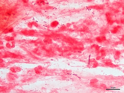 Haemophilus and S. pneumoniae pneumonia 04