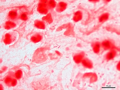 Gram negative pneumonia 01