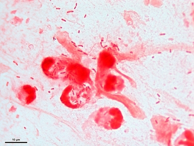 Gram negative pneumonia 02