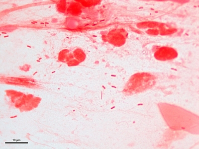 Gram negative pneumonia 03