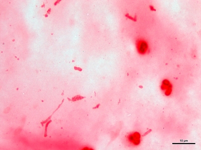 Klebsiella pneumoniae pneumonia 03