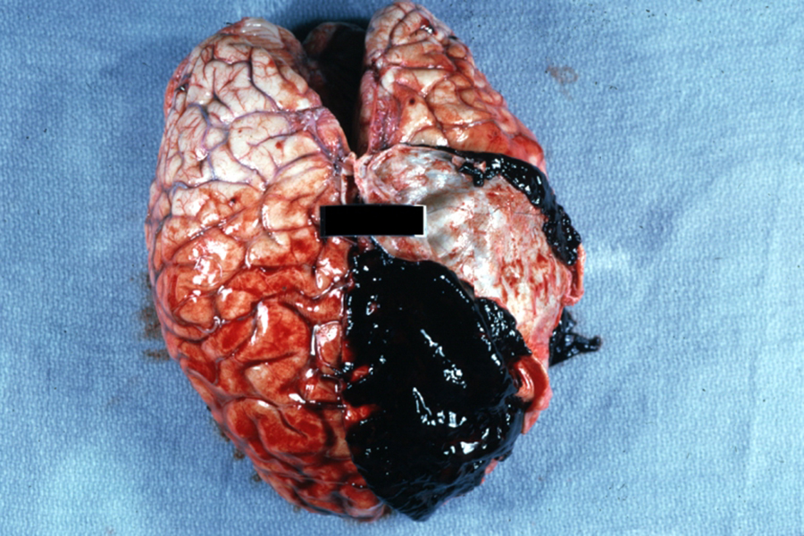 Brain - subdural hematoma