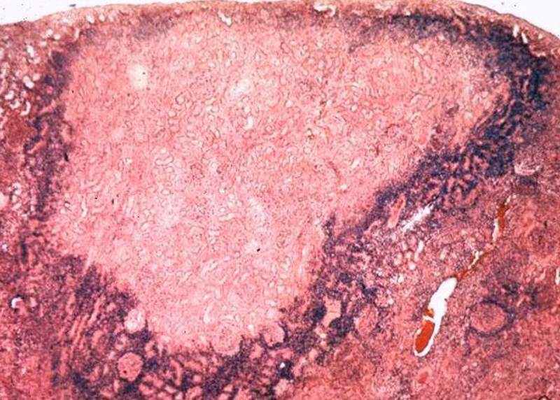 Acute renal infarct