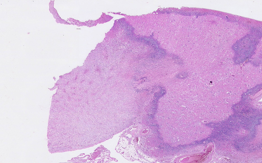 Slide 5: Kidney - acute renal infarct