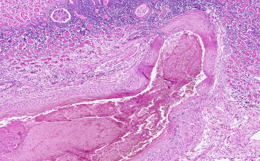 Slide 5: Kidney - acute renal infarct