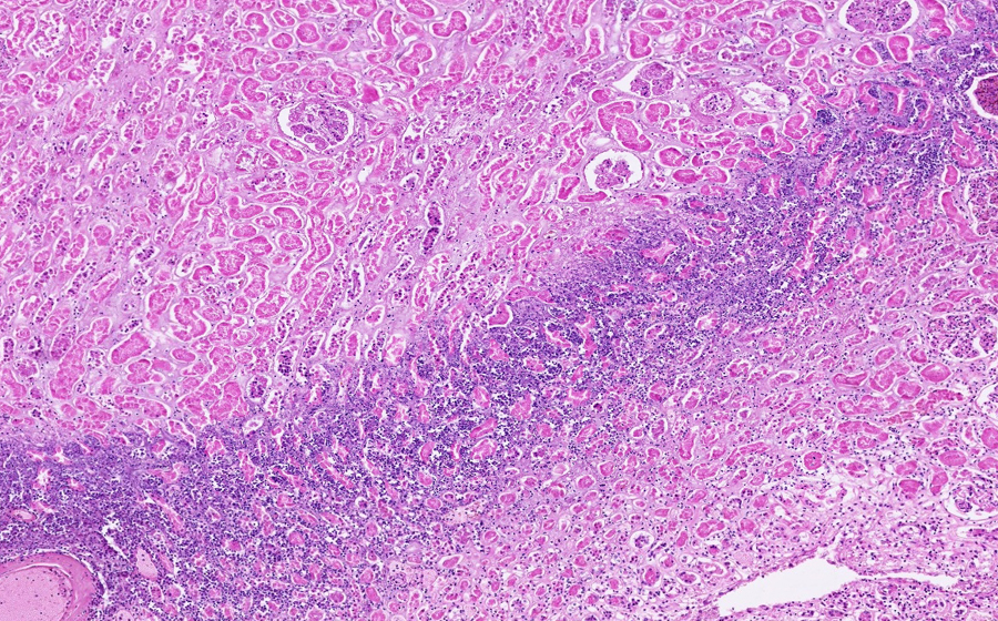 Slide 5: Kidney - acute renal infarct