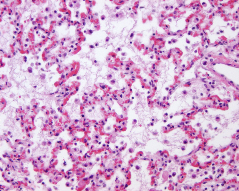 Fibrin - lung