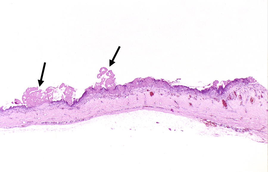 Fibrinous pericarditis