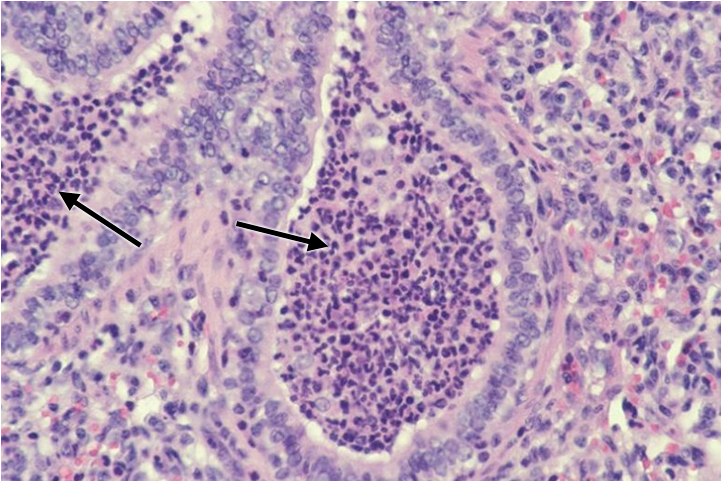 Purulent bronchopneumonia