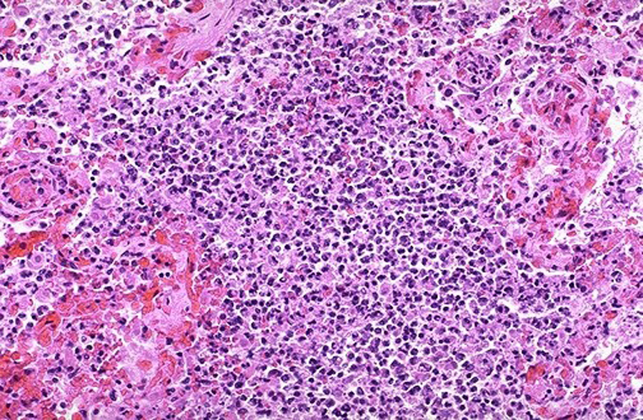 Acute bronchopneumonia