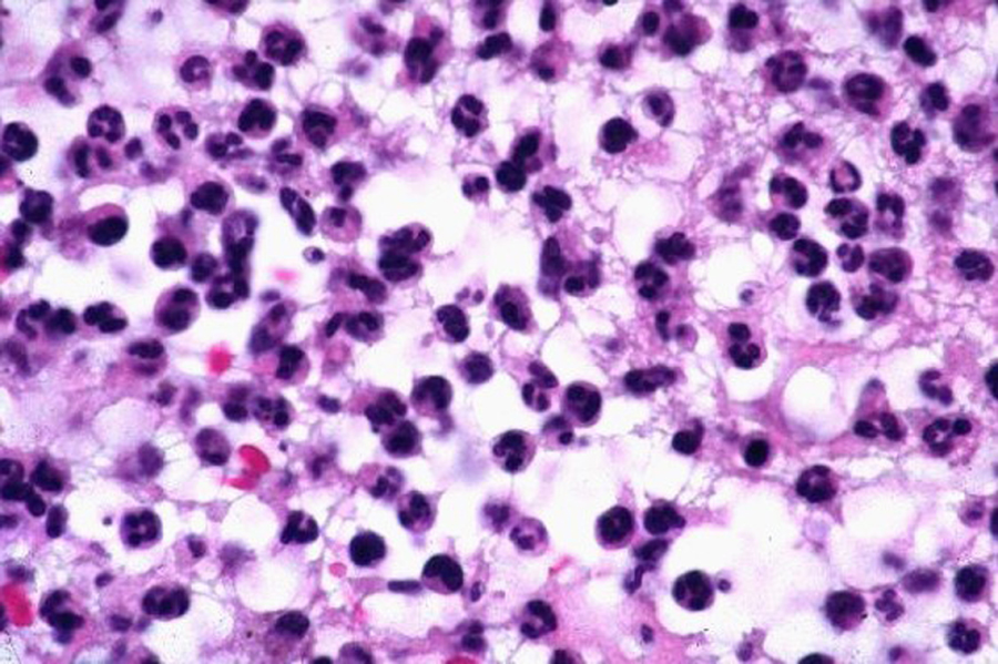Neutrophils and fibrin