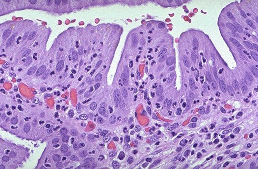 Acute cholecystitis
