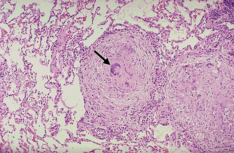 Pulmonary granulomas - tuberculosis