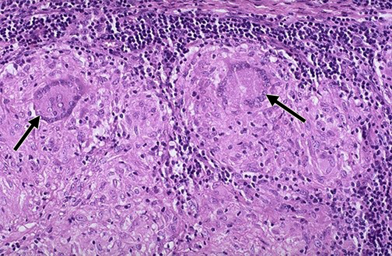 Granulomatous inflammation - lymph node