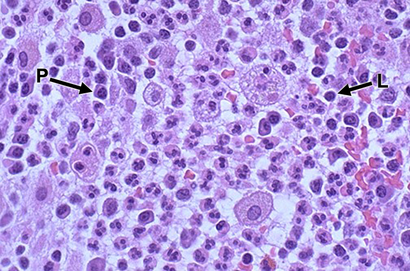 Image 22: Inflammatory cells