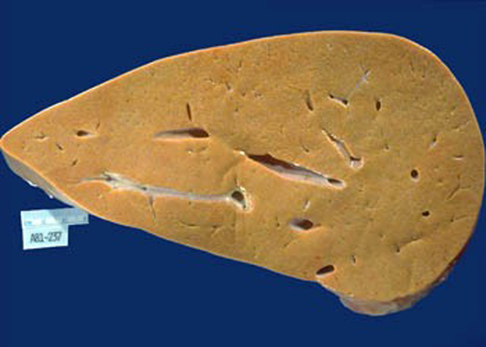 Hepatic steatosis