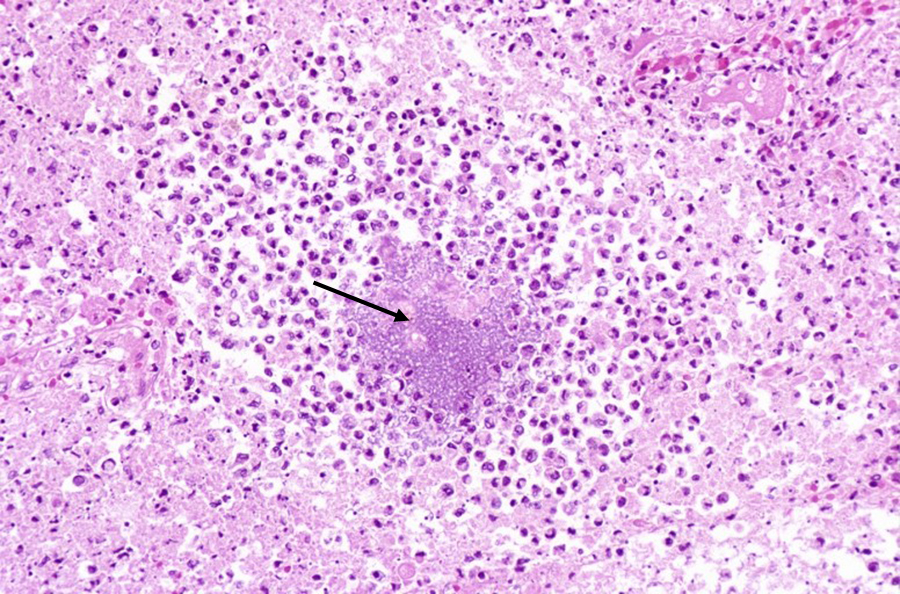 Liquefactive necrosis - lung abscess