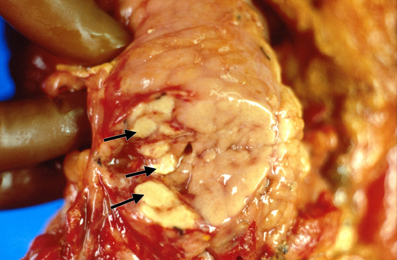 Acute pancreatitis