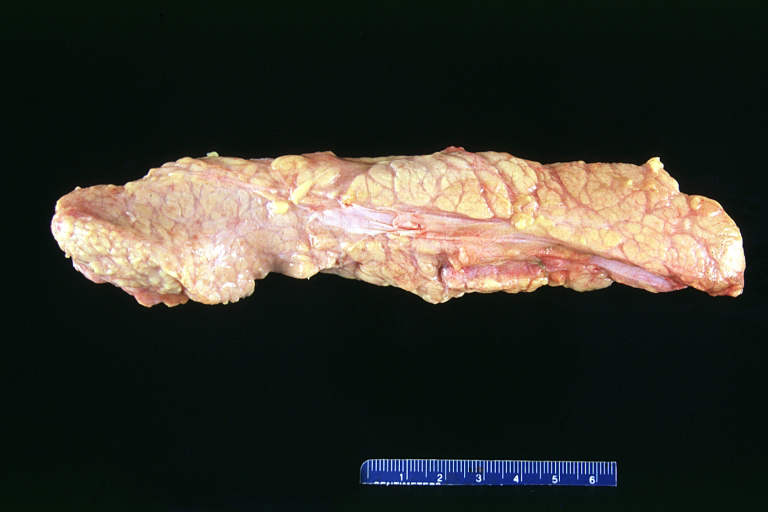 Normal pancreas