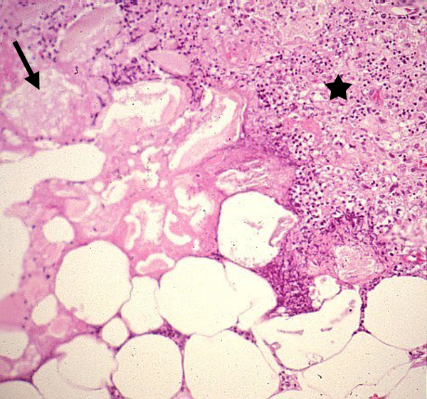 Peripancreatic adipose tissue