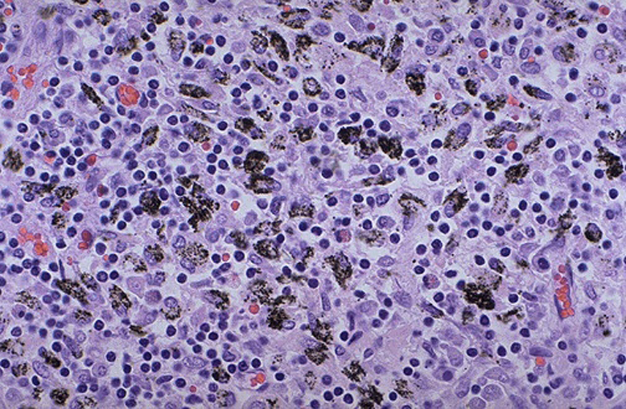 Anthracosis - pulmonary hilar lymph node