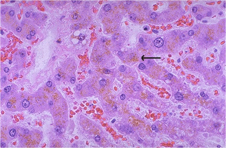 Lipofuscin - hepatocytes