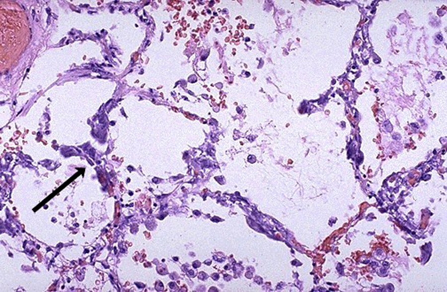 Metastatic calcification - lung