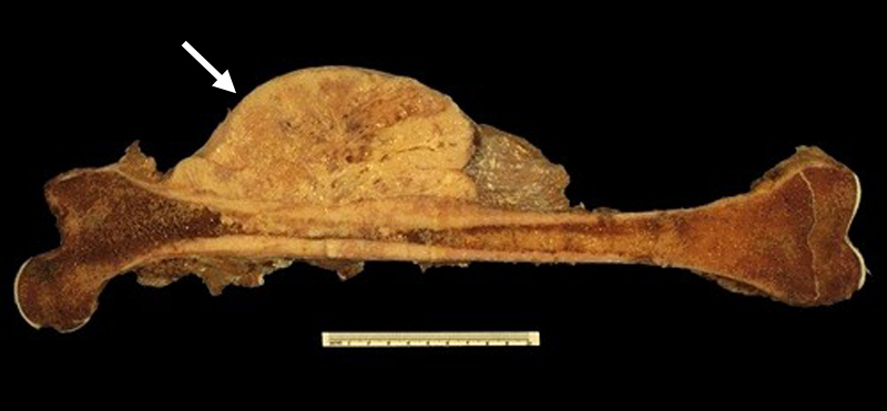 Femur - osteosarcoma
