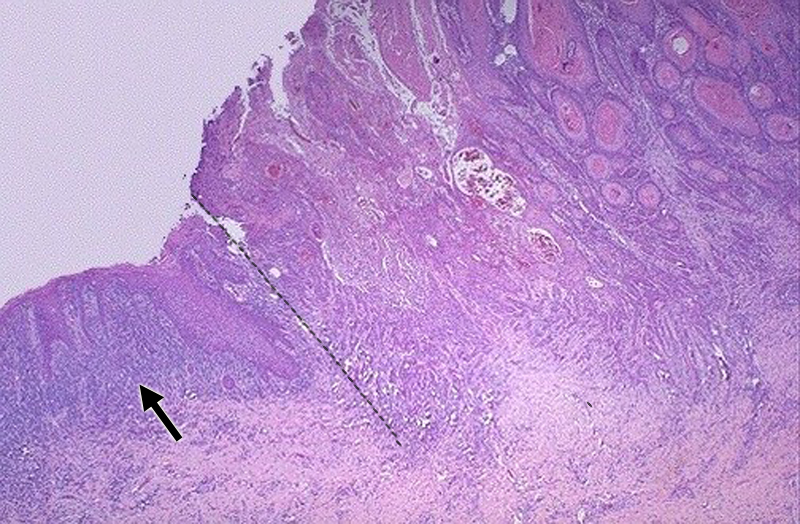 Image 22: Cervix - squamous cell carcinoma