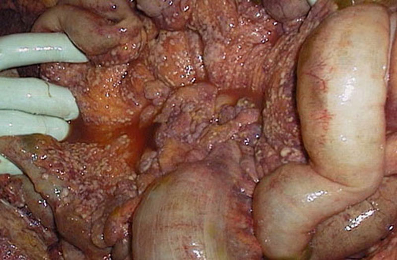 Abdomen - carcinoma seeding peritoneal surfaces