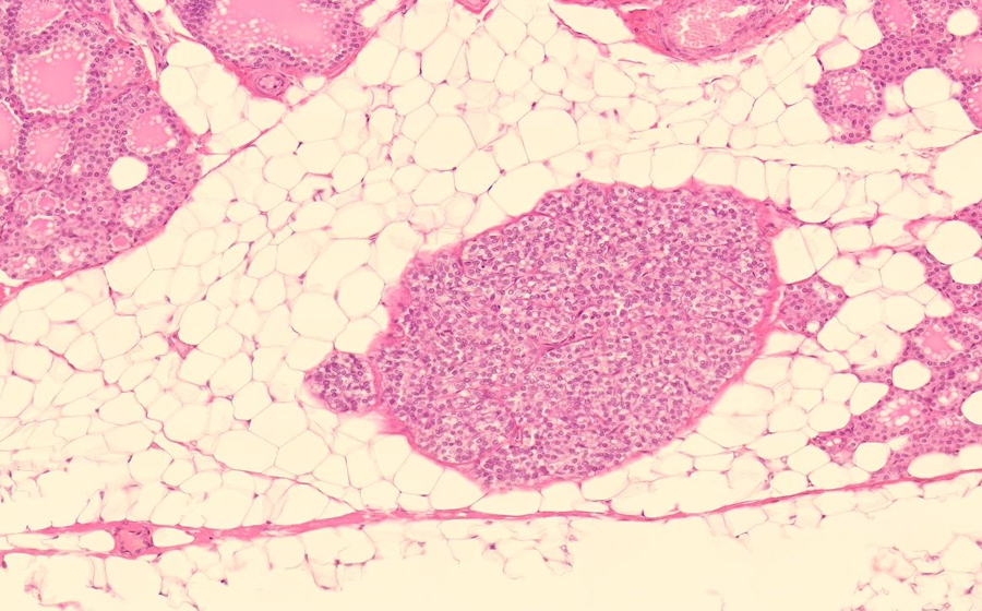 Parathyroid