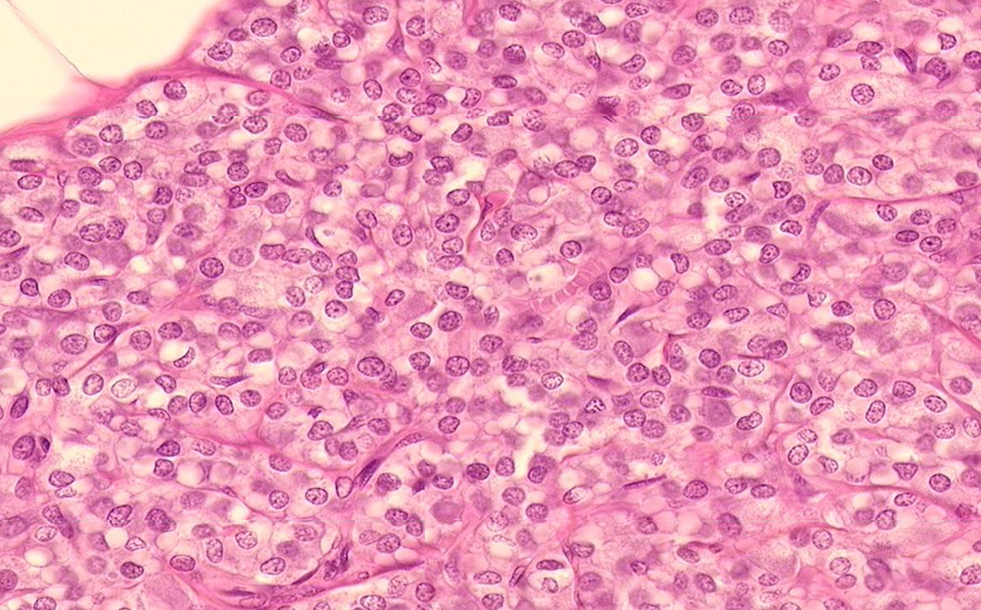 Parathyroid
