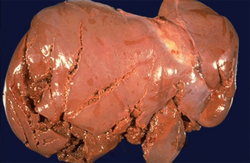 Liver