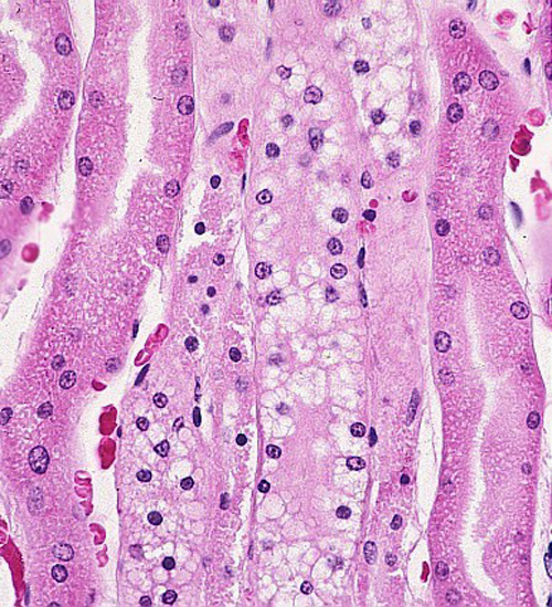 Cell swelling - renal tubular epithelium
